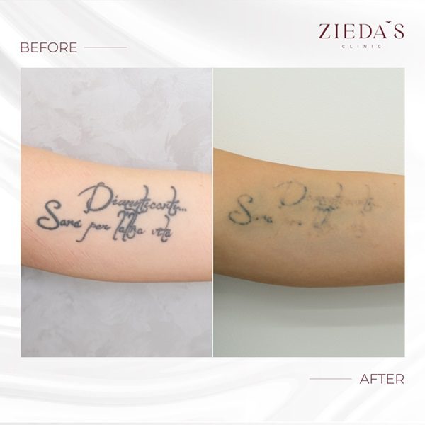 tattoo removal cost - Archive - Laser Tattoo Removal Sydney - Tattoo  Removal Guarantee
