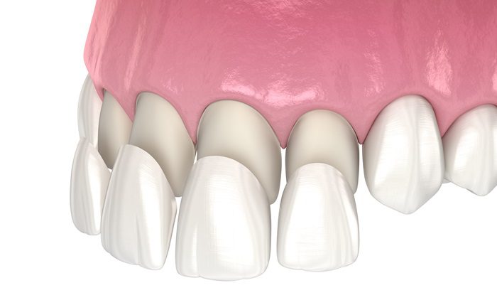 dental veneers animated