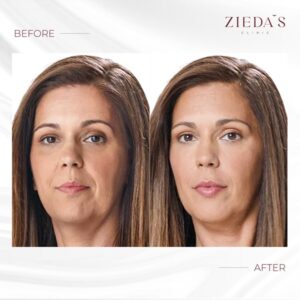 juvederm dermal filler before and after