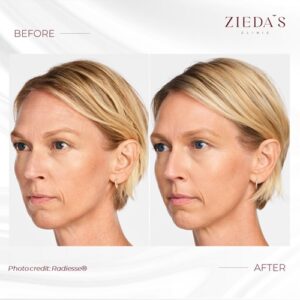 radiesse filler before and after