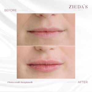restylane lips in dubai