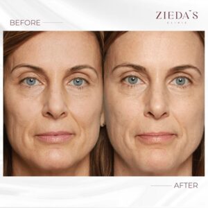sculptra injections before and after