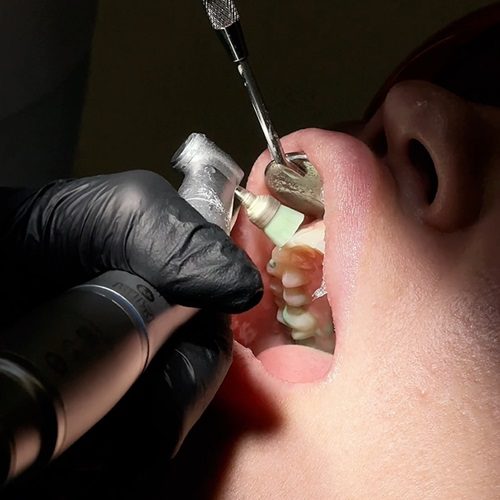 teeth polishing dubai